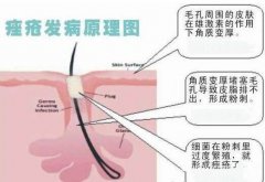 痤瘡治療的誤區有什么？痤瘡的治療要警惕哪些